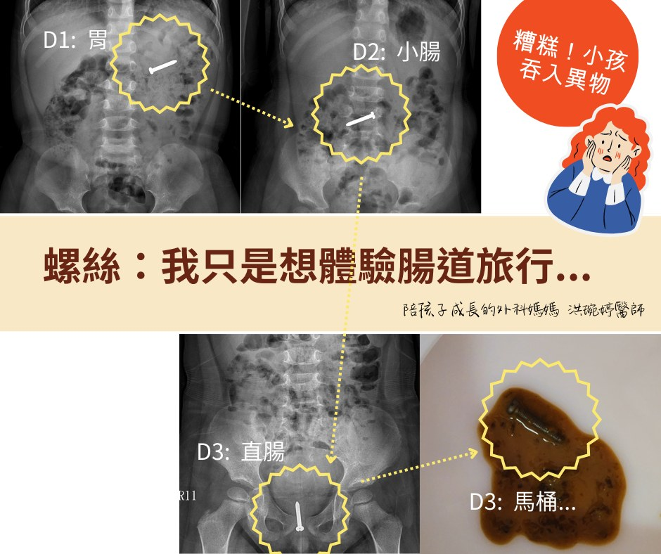 孩子誤食異物怎麼辦？
