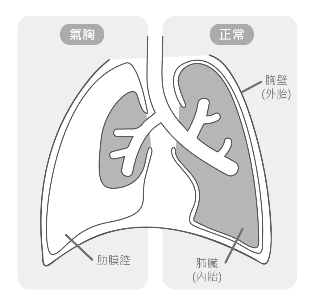 肺怎麼破胎了！--原發性自發性氣胸